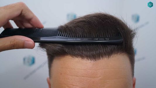 Injerto Capilar Técnica FUE Grafts 2006 (4905 Pelos) 34 35 RESULTADOS A LOS MESES