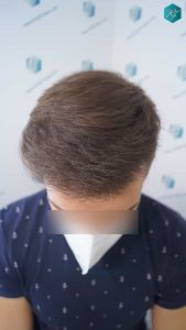 Injerto Capilar Técnica FUE Grafts 2006 (4905 Pelos) 24 36 RESULTADOS A LOS MESES