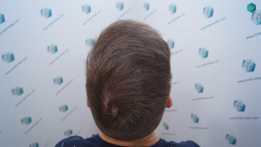 Injerto Capilar Técnica FUE Grafts 2006 (4905 Pelos) 37 37 RESULTADOS A LOS MESES