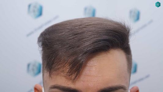 Injerto Capilar Técnica FUE Grafts 2006 (4905 Pelos) 39 39A RESULTADOS A LOS 12 MESES
