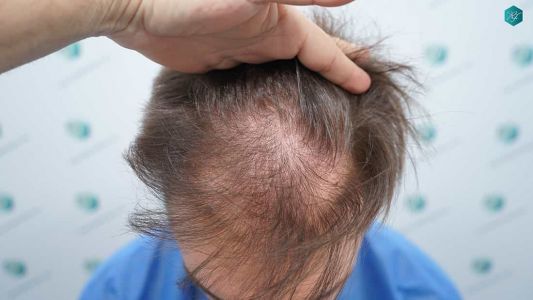 Injerto Capilar Técnica FUE Grafts 2006 (4905 Pelos) 3 4 ANTES DEL TRASPLANTE CAPILAR