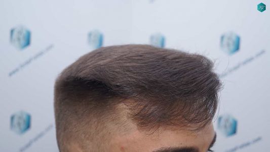 Injerto Capilar Técnica FUE Grafts 2006 (4905 Pelos) 40 40 RESULTADOS A LOS 12 MESES