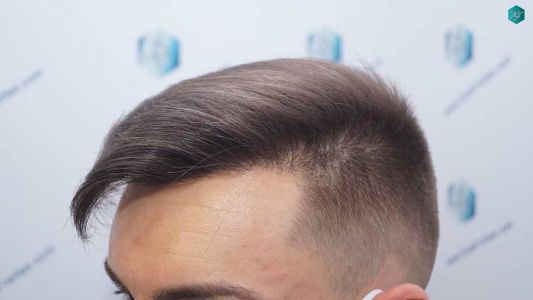 Injerto Capilar Técnica FUE Grafts 2006 (4905 Pelos) 41 41 RESULTADOS A LOS 12 MESES