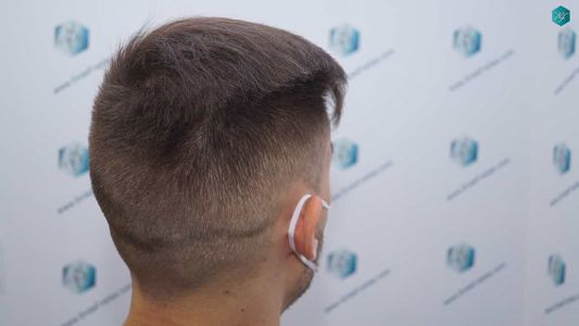Injerto Capilar Técnica FUE Grafts 2006 (4905 Pelos) 42 41A RESULTADOS A LOS 12 MESES