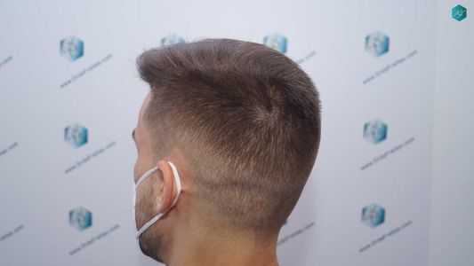 Injerto Capilar Técnica FUE Grafts 2006 (4905 Pelos) 43 41B RESULTADOS A LOS 12 MESES