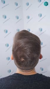 Injerto Capilar Técnica FUE Grafts 2006 (4905 Pelos) 47 45 RESULTADOS A LOS 12 MESES