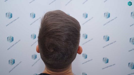 Injerto Capilar Técnica FUE Grafts 2006 (4905 Pelos) 48 46 RESULTADOS A LOS 12 MESES