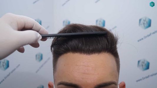 Injerto Capilar Técnica FUE Grafts 2006 (4905 Pelos) 49 47 RESULTADOS A LOS 12 MESES