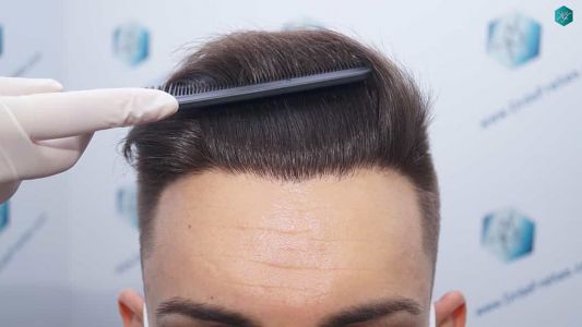 Injerto Capilar Técnica FUE Grafts 2006 (4905 Pelos) 50 48 RESULTADOS A LOS 12 MESES