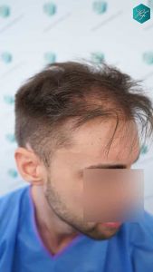 Injerto Capilar Técnica FUE Grafts 2006 (4905 Pelos) 6 ANTES DEL TRASPLANTE CAPILAR