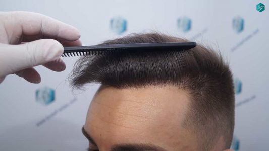 Injerto Capilar Técnica FUE Grafts 2006 (4905 Pelos) 53 52 RESULTADOS A LOS 12 MESES