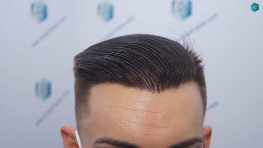 Injerto Capilar Técnica FUE Grafts 2006 (4905 Pelos) 55 54A RESULTADOS A LOS 12 MESES