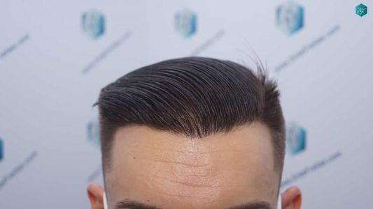 Injerto Capilar Técnica FUE Grafts 2006 (4905 Pelos) 56 54B RESULTADOS A LOS 12 MESES
