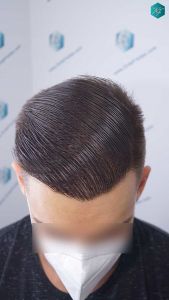 Injerto Capilar Técnica FUE Grafts 2006 (4905 Pelos) 57 55 RESULTADOS A LOS 12 MESES