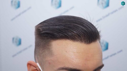 Injerto Capilar Técnica FUE Grafts 2006 (4905 Pelos) 58 56 RESULTADOS A LOS 12 MESES