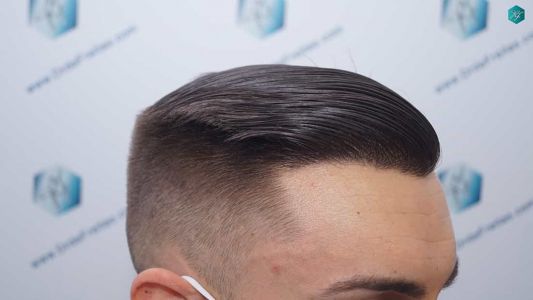 Injerto Capilar Técnica FUE Grafts 2006 (4905 Pelos) 59 57 RESULTADOS A LOS 12 MESES