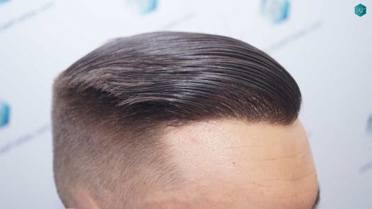 Injerto Capilar Técnica FUE Grafts 2006 (4905 Pelos) 60 58 RESULTADOS A LOS 12 MESES