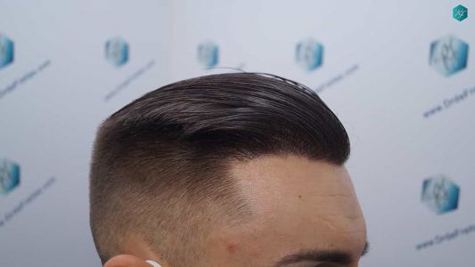 Injerto Capilar Técnica FUE Grafts 2006 (4905 Pelos) 61 59 RESULTADOS A LOS 12 MESES