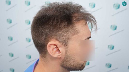 Injerto Capilar Técnica FUE Grafts 2006 (4905 Pelos) 4 5A ANTES DEL TRASPLANTE CAPILAR
