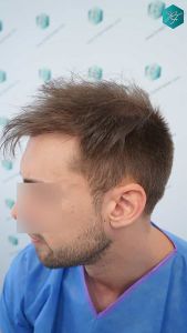 Injerto Capilar Técnica FUE Grafts 2006 (4905 Pelos) 7 6 ANTES DEL TRASPLANTE CAPILAR