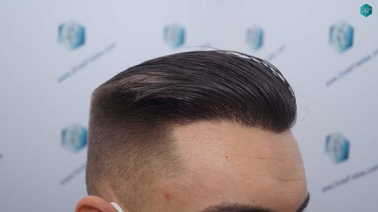 Injerto Capilar Técnica FUE Grafts 2006 (4905 Pelos) 62 60 RESULTADOS A LOS 12 MESES