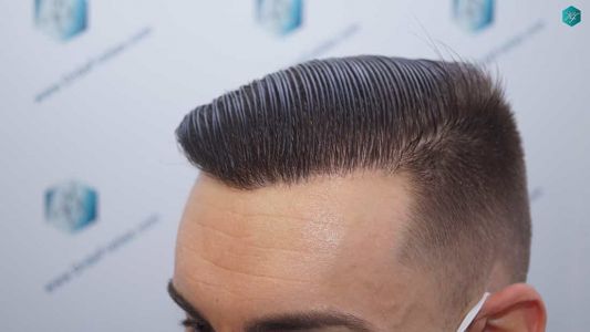 Injerto Capilar Técnica FUE Grafts 2006 (4905 Pelos) 63 61 RESULTADOS A LOS 12 MESES