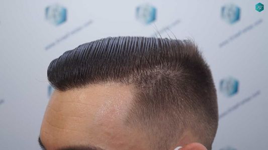 Injerto Capilar Técnica FUE Grafts 2006 (4905 Pelos) 64 62 RESULTADOS A LOS 12 MESES