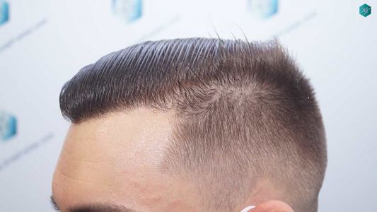 Injerto Capilar Técnica FUE Grafts 2006 (4905 Pelos) 65 63 RESULTADOS A LOS 12 MESES