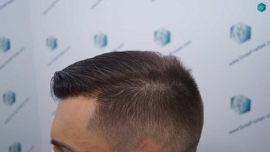 Injerto Capilar Técnica FUE Grafts 2006 (4905 Pelos) 66 65 RESULTADOS A LOS 12 MESES