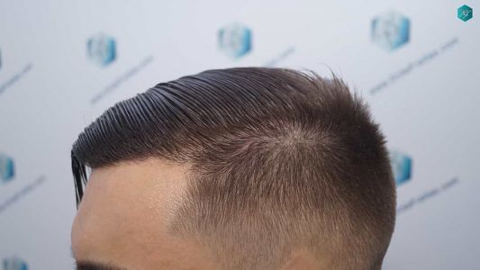 Injerto Capilar Técnica FUE Grafts 2006 (4905 Pelos) 68 67 RESULTADOS A LOS 12 MESES