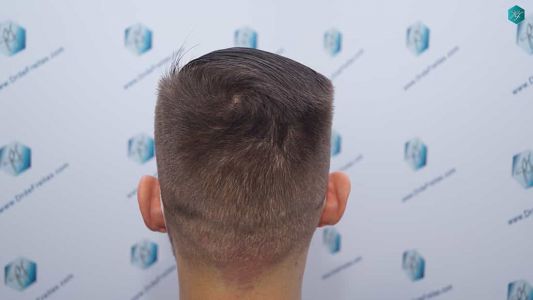 Injerto Capilar Técnica FUE Grafts 2006 (4905 Pelos) 69 68 RESULTADOS A LOS 12 MESES