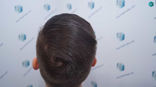 Injerto Capilar Técnica FUE Grafts 2006 (4905 Pelos) 70 69 RESULTADOS A LOS 12 MESES