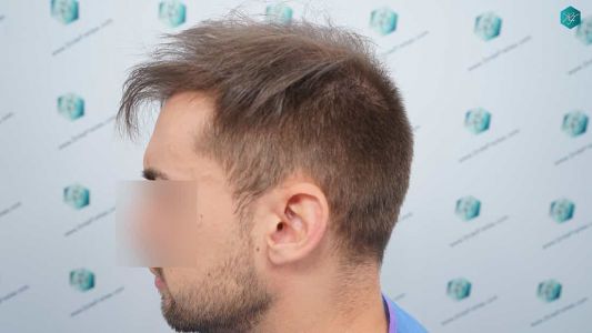 Injerto Capilar Técnica FUE Grafts 2006 (4905 Pelos) 5 6A ANTES DEL TRASPLANTE CAPILAR