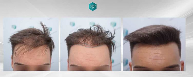 Injerto Capilar Técnica FUE Grafts 2006 (4905 Pelos) 72 COMPARATIVAS