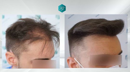 Injerto Capilar Técnica FUE Grafts 2006 (4905 Pelos) 71 COMPARATIVAS 2