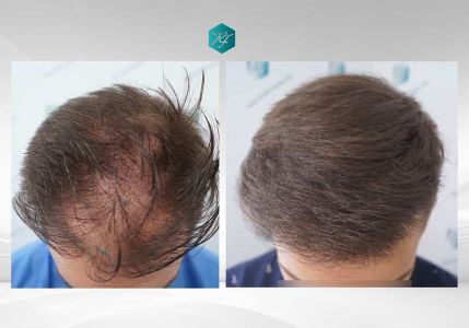 Injerto Capilar Técnica FUE Grafts 2006 (4905 Pelos) 74 COMPARATIVAS 5