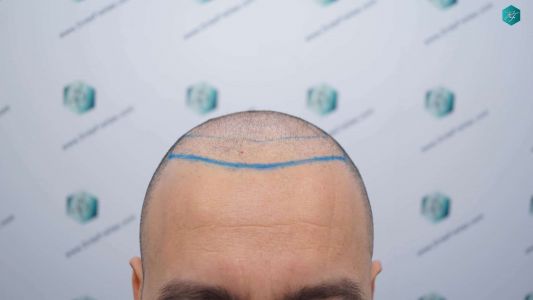 Injerto Capilar Técnica FUE Grafts 4.516 (11.888 Pelos) 10 10 DISENO LINEA DE INJERTO