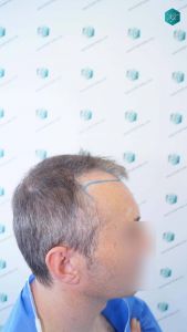 Injerto Capilar Técnica FUE Grafts 4924 (11170 Pelos) 9 10 DISENO LINEA INJERTO 1