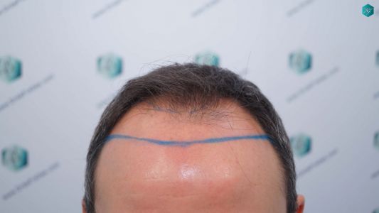 Injerto Capilar Técnica FUE Grafts 3362 (8806 Pelos) 7 10 DISENO LINEA INJERTO CAPILAR