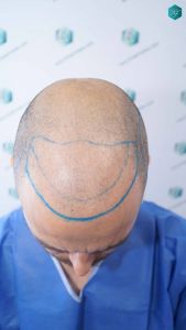 Injerto Capilar Técnica FUE Grafts 4.516 (11.888 Pelos) 11 11 DISENO LINEA DE INJERTO
