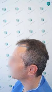 Injerto Capilar Técnica FUE Grafts 4924 (11170 Pelos) 10 11 DISENO LINEA INJERTO 1