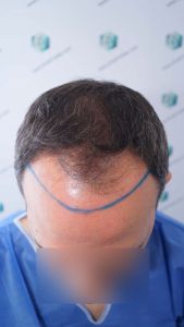 Injerto Capilar Técnica FUE Grafts 3362 (8806 Pelos) 8 11 DISENO LINEA INJERTO CAPILAR