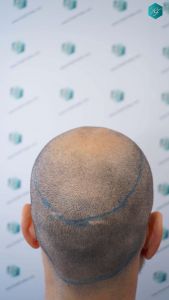 Injerto Capilar Técnica FUE Grafts 4.516 (11.888 Pelos) 12 12 DISENO LINEA DE INJERTO