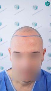 Injerto Capilar Técnica FUE Grafts 3362 (8806 Pelos) 9 12 DISENO LINEA INJERTO CAPILAR