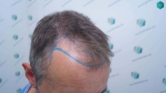 Injerto Capilar Técnica FUE Grafts 4924 (11170 Pelos) 7 12 DISENO LINEA INJERTO
