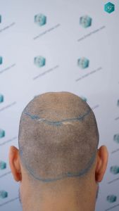 Injerto Capilar Técnica FUE Grafts 4.516 (11.888 Pelos) 13 13 DISENO LINEA DE INJERTO