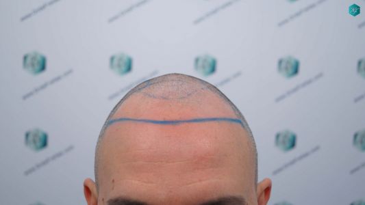 Injerto Capilar Técnica FUE Grafts 3362 (8806 Pelos) 11 13 DISENO LINEA INJERTO CAPILAR