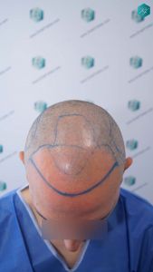 Injerto Capilar Técnica FUE Grafts 3362 (8806 Pelos) 10 14 DISENO LINEA INJERTO CAPILAR