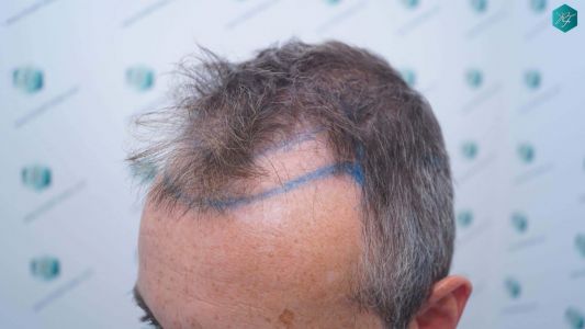 Injerto Capilar Técnica FUE Grafts 4924 (11170 Pelos) 8 14 DISENO LINEA INJERTO