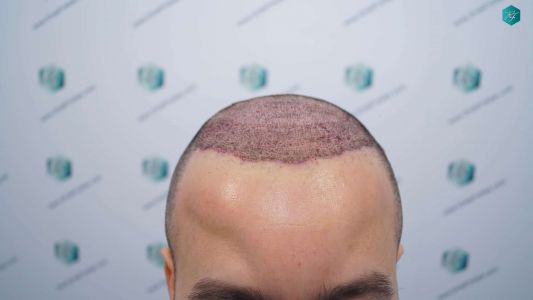 Injerto Capilar Técnica FUE Grafts 4.516 (11.888 Pelos) 14 15 DISENO LINEA DE INJERTO